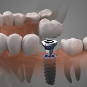 Імплантація