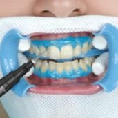Система відбілювання зубів Beyond Polus Advanced