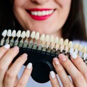 Домашнє відбілювання